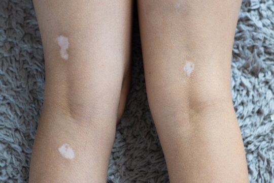 Close-up of child legs with vitiligo patches on skin