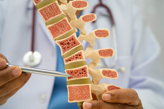 Doctor holding osteoporosis in back bone model for treatment medical in orthopedic department.