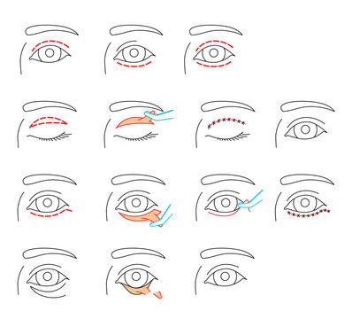 Blepharoplasty. Various cuts and consequences