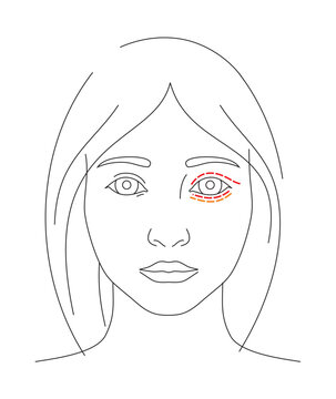 Illustration of blepharoplasty