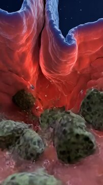3D visualization of gallstones obstructing the bile duct