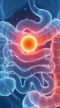 3D medical render of an intestinal bowel obstruction
