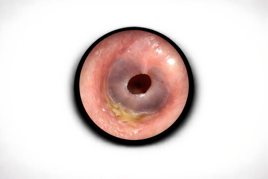 Photorealistic 3D medical-grade otoscopic view showing mild otorrhea consistent with chronic otitis media: small amount of yellowish mucoid discharge thinly coating part of the ear canal wall