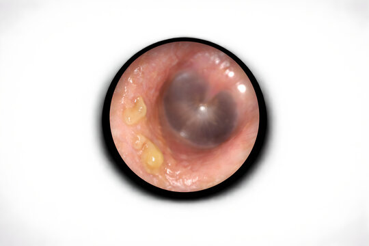 Photorealistic 3D medical-grade otoscopic view showing mild otorrhea consistent with chronic otitis media: small amount of yellowish mucoid discharge thinly coating part of the ear canal wall