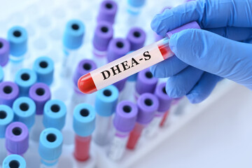 Fototapeta premium Doctor holding DHEA S blood test tube explaining adrenal androgen hormone levels, endocrine balance evaluation and diagnosis of hormonal disorders in clinical laboratory diagnostics