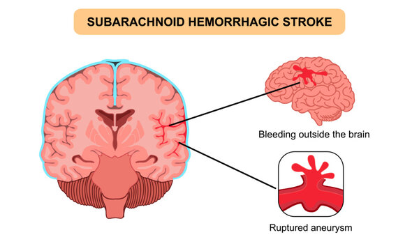 Brain stroke hemorrhagic subarachnoid. Ruptured aneurysm, bleeding outside teh brain. Arteriosclerosis, infarct, ischemia, thrombosis disease. Medical poster vector illustration and education.