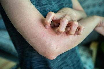 Cropped shot view of woman scratching her skin after rashes occur. A rash on your arms can occur due to an allergic reaction, contact with irritants, infection, or an underlying medical condition like © boyloso