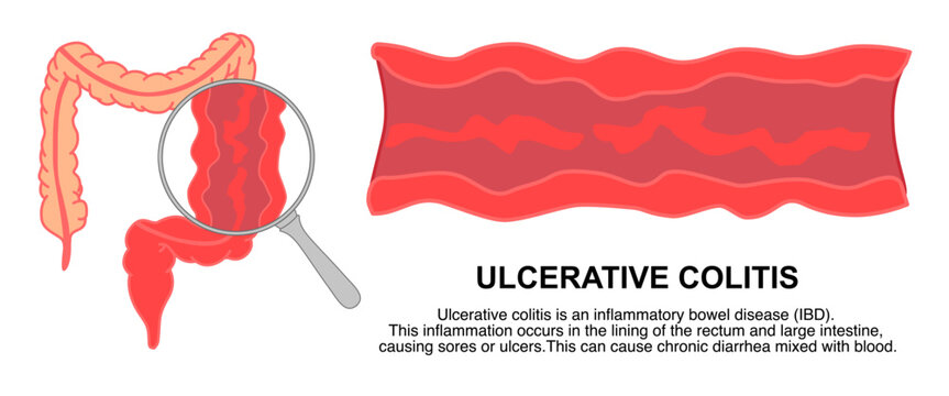 Illustration of ulcerative colitis, inflammatory bowel disease. Inflammation of the human digestive system. Flat vector illustration for medical, science, and educational posters.