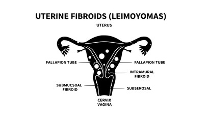 Uterine Fibroids Female Reproductive System Anatomy Diagram Vector
