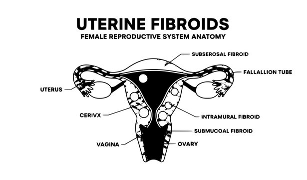 Female Reproductive System with Uterine Fibroids Labeled Anatomy