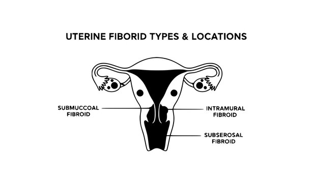 Types of Uterine Fibroids Location Medical Vector Illustration
