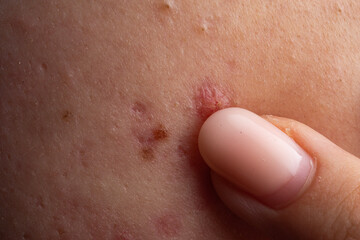 Fototapeta premium Acne and pimple,on skin closeup. Acne macro, pimple on skin. Pimple texture in pores. Pimple macro for dermatology.