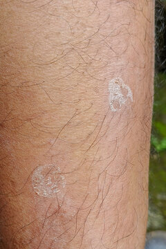 Vertical image close up of tinea versicolor on a man's leg. Concept of skin disease with white fungal spots. For graphic design, 3D rendering and banners