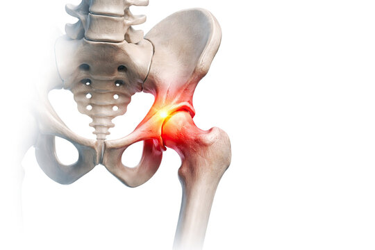 Human hip joint with pelvis bones showing inflammation and pain at hip socket isolated on white background