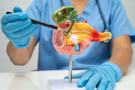Pancreatitis, pancreatic cancer, Asian doctor with pancreas, gallbladder and bile duct human anatomy model at hospital.