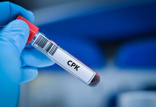 Blood sample tube for CPK test analysis.