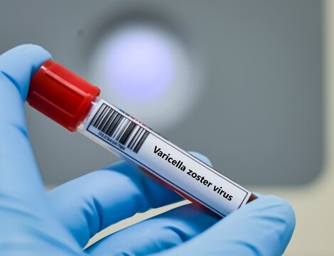 Blood sample tube for varicella zoster virus test analysis.