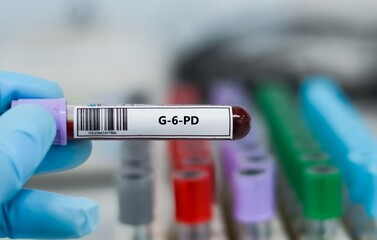 Obraz premium Blood sample tube for G-6-PD test analysis.