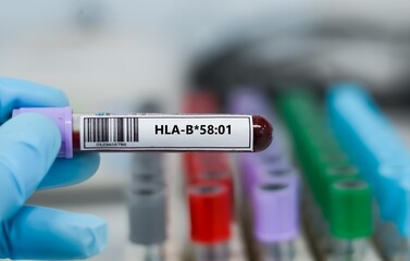 Obraz premium Blood sample tube for sickle HLA-B*58:01 test analysis.