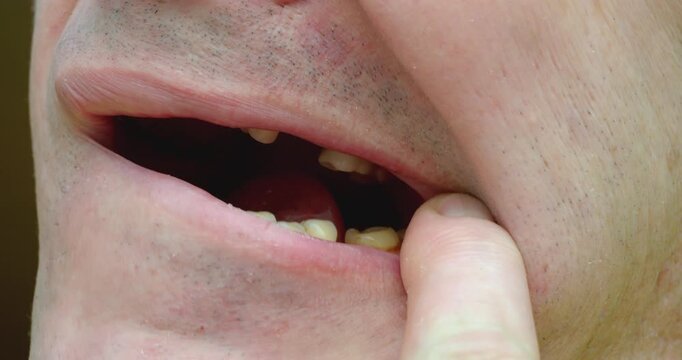 Man checking his unhealthy and missing teeth