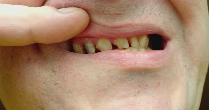 Man showing rotten and broken teeth problem