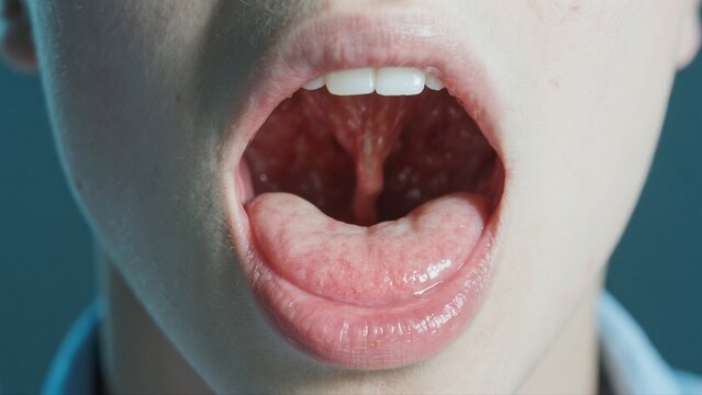 Tonsil cancer is a malignant tumor that forms in the tissues of the tonsils, often associated with HPV infection, smoking, and alcohol use. Common symptoms include sore throat, ear pain, difficulty sw