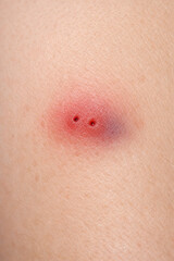 Painful Bite: Close-Up of Inflamed Skin with Two Puncture Wounds on Human Body