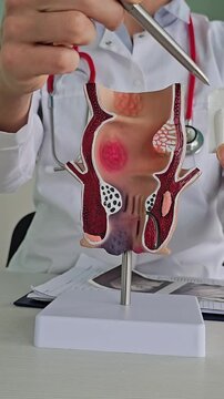 A suppository and a rectum. A proctologist inserts a rectal suppository and an artificial model of the human rectum