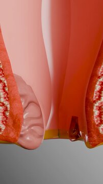internal and external hemorrhoids piles, Human Anatomy Cross section, fistula, fissure, Virus infection in anal canal or lower rectum, treatment and prevention concept, external thrombosis, 3d render