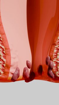 internal and external hemorrhoids piles, Human Anatomy Cross section, fistula, fissure, Virus infection in anal canal or lower rectum, treatment and prevention concept, external thrombosis, 3d render 