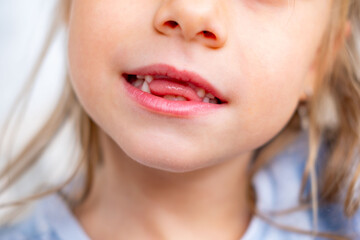 Fototapeta premium happy positive funny toothless 6-year-old girl, Close-up smiling child's face, showcasing missing baby teeth and joyful expression, waiting for toothfairy, innocence, growth, and childhood milestones