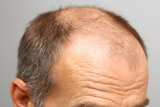 Man with shaved head looking down, highlighting scalp and baldness for hair loss awareness