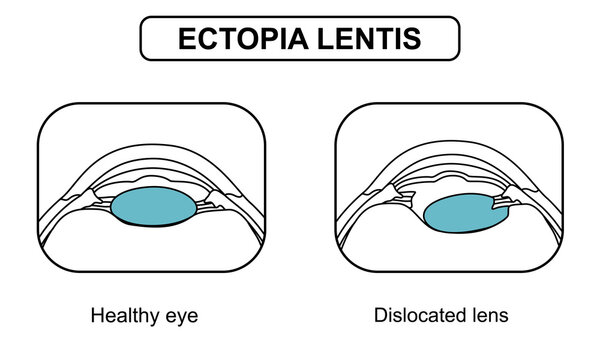 Ectopia lentis illustration, torn zonular fibers. Healthy eyes and vision disorders, genetic diseases. Ophthalmology appointment. Vector illustration of eye health, poster for medical and education