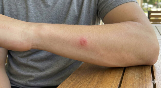Red spot from insect bite on male arm skin close up.