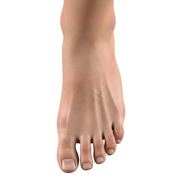 Close-up of a human foot with hammertoe condition on all toes.
