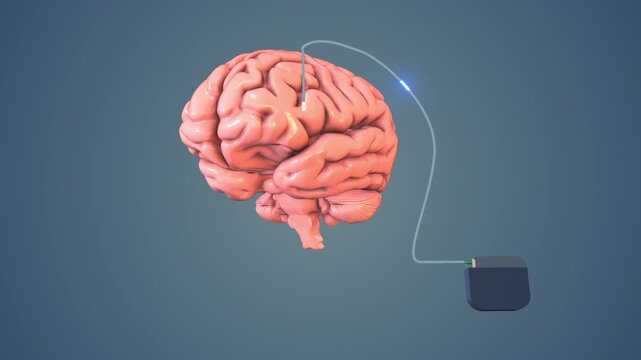 Implanted Neurostimulator Connected to Human Brain