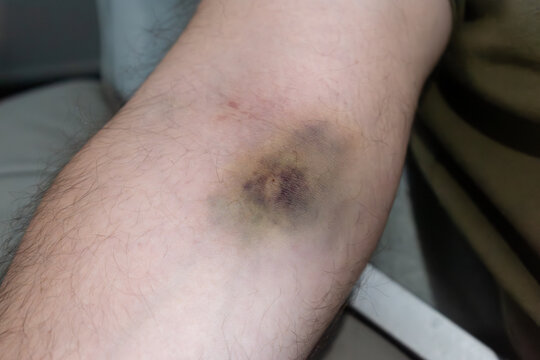 Bruise on arm after blood test, hematoma