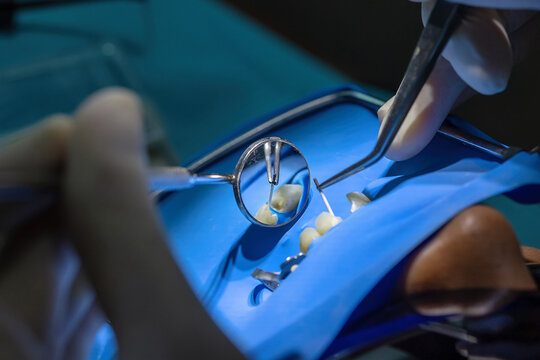 Root canal treatment under rubber dam isolation. Dentist working with endodontic instruments for precise cleaning and shaping of infected tooth canals.