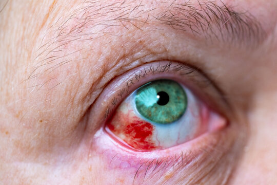 Close-up human eye with severe redness and broken blood vessels, showing subconjunctival hemorrhage, clinical detail for medical, health, and ophthalmology concepts, patient healing, blood vessel