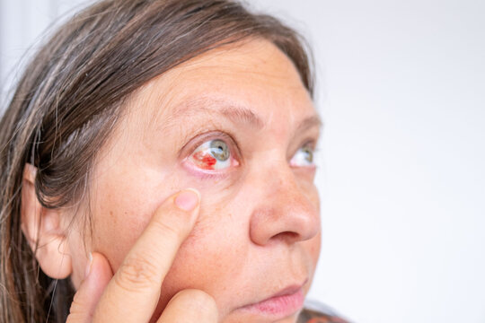 Close-up human eye with severe redness and broken blood vessels, showing subconjunctival hemorrhage, clinical detail for medical, health, and ophthalmology concepts, patient healing, blood vessel