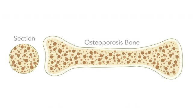 Osteoporosis, porous bone steps animation. Cross section, structure. Pair, normal, health, mass, pore, fragile, spongy, osteoporotic bone, anatomy diagram. White back, textures. Medical video footage