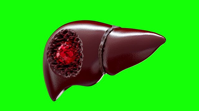 Fatty liver disease and liver cancer concepts. Red cancerous mass is eating away at and invading the liver. for medical education and 3D healthcare perception render on green screen.