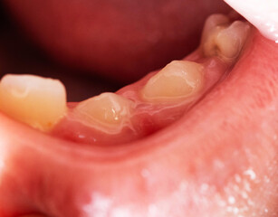 Close-up view of child oral cavity showing permanent teeth erupting behind primary teeth, dental development stage of mixed dentition