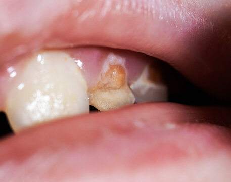 Close up view of damaged milk tooth in child mouth showing enamel hypoplasia and early decay development with visible discoloration