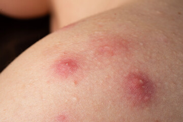 Fototapeta premium Acne skin pimple. Skin problem with inflamed bumps. Irritated skin texture. Close up skin issue.