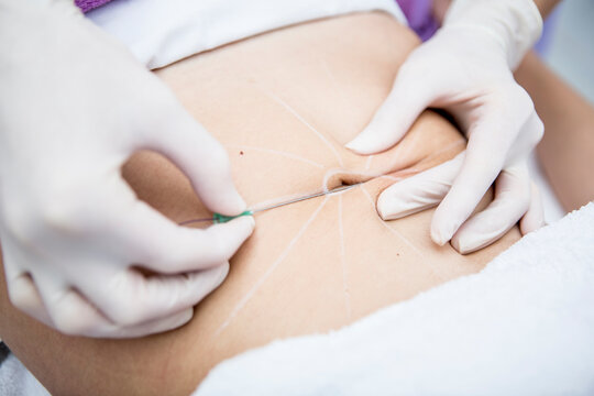 Aesthetic surgery, mesothreads, lifting