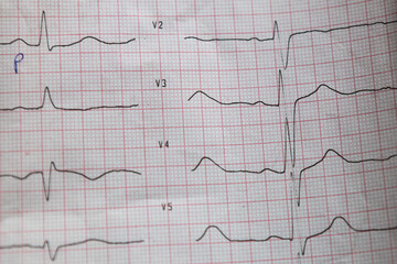 Medical test results show electrocardiogram readings from a patient's heart activity during a health assessment in a clinic