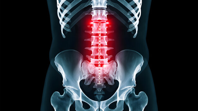 X ray human spine with red glowing pain points on lumbar vertebrae and pelvis skeleton
