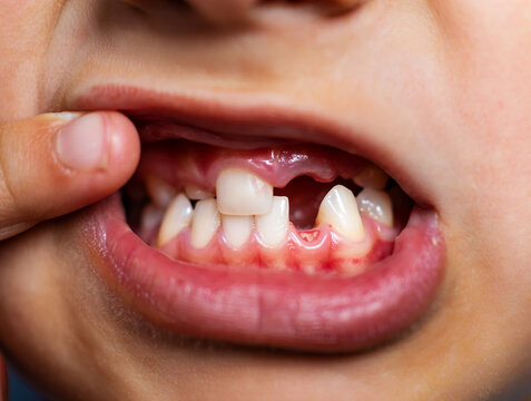 Child mouth showing missing front teeth and one loose tooth image