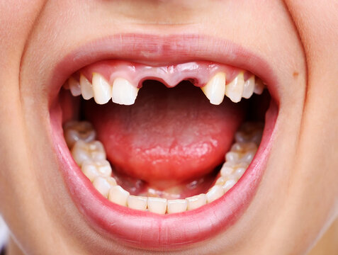 Close up of open mouth with missing front teeth and pink gums image